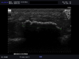 Ultrazvok kolena - kalcinacije v patelarnem ligamentu, indikacija za ESWT